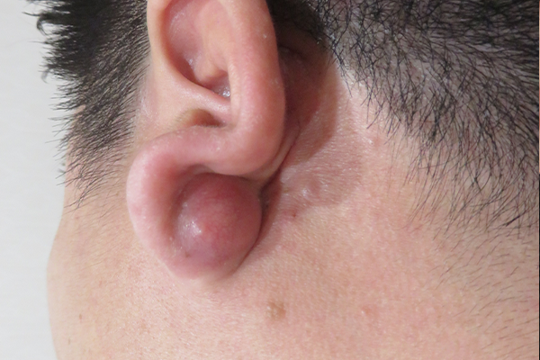 炎症性粉瘤　耳後部